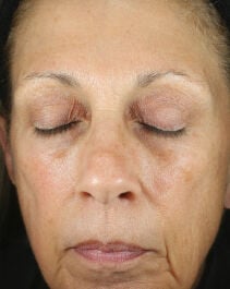 Renewal Crème  before-after-1