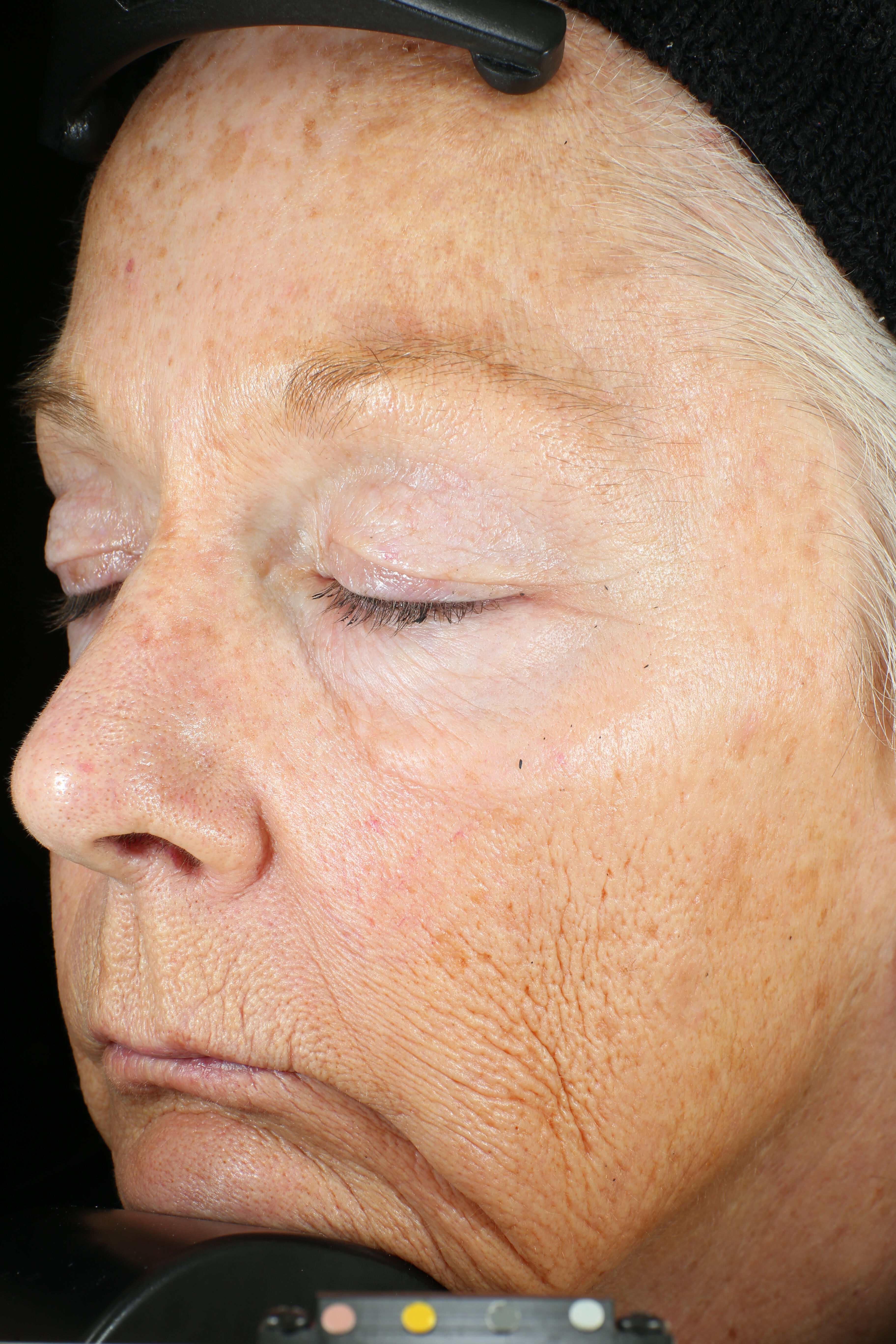 Wrinkle + Texture Repair  before-after-1