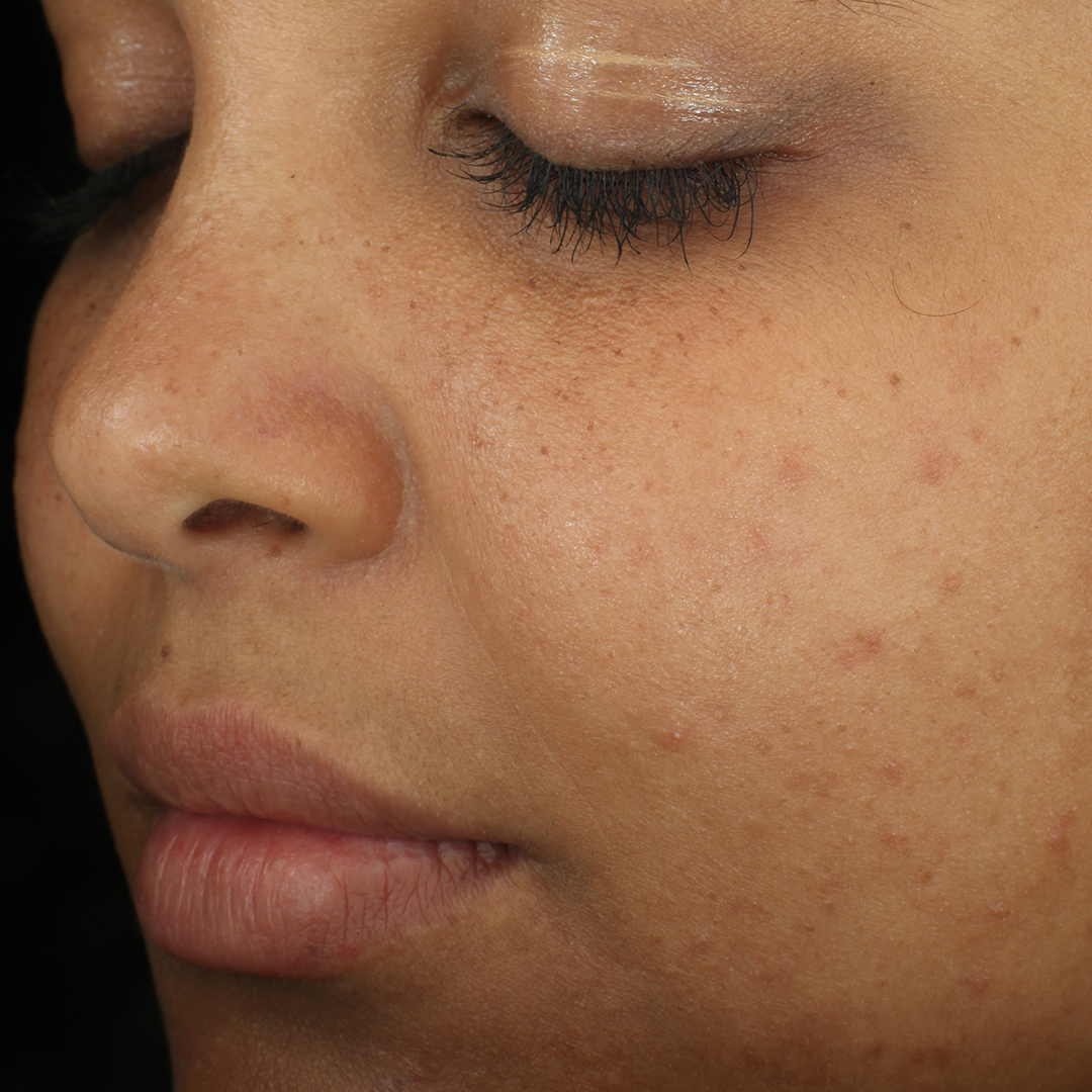 Complexion Clarifying Serum  before-after-4