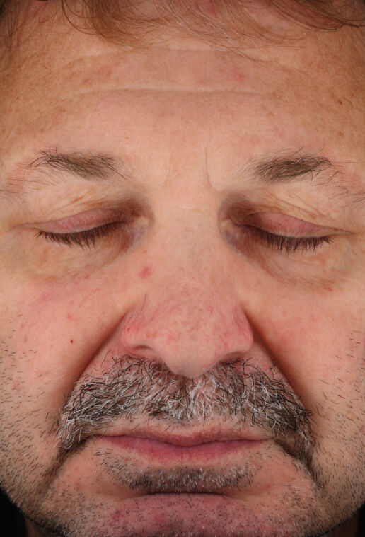 Rozatrol&reg;  before-after-2