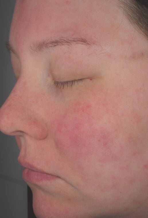 Hydrating Cr&egrave;me  before-after-2