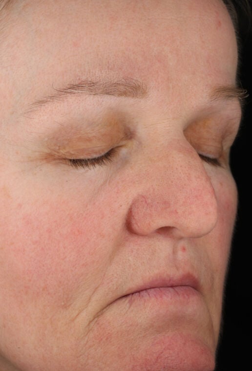 Rozatrol&reg;  before-after-3