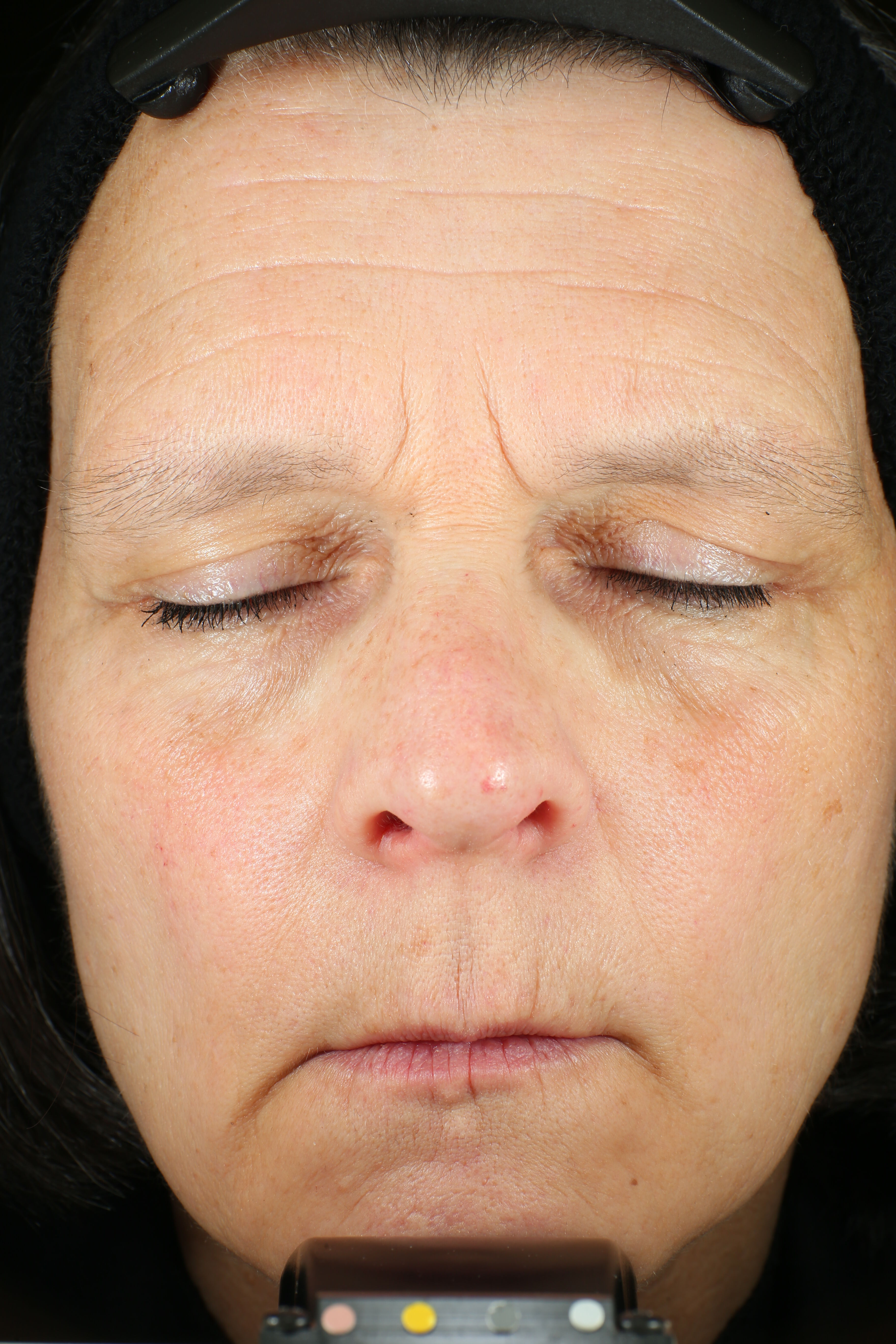 Wrinkle + Texture Repair  before-after-2