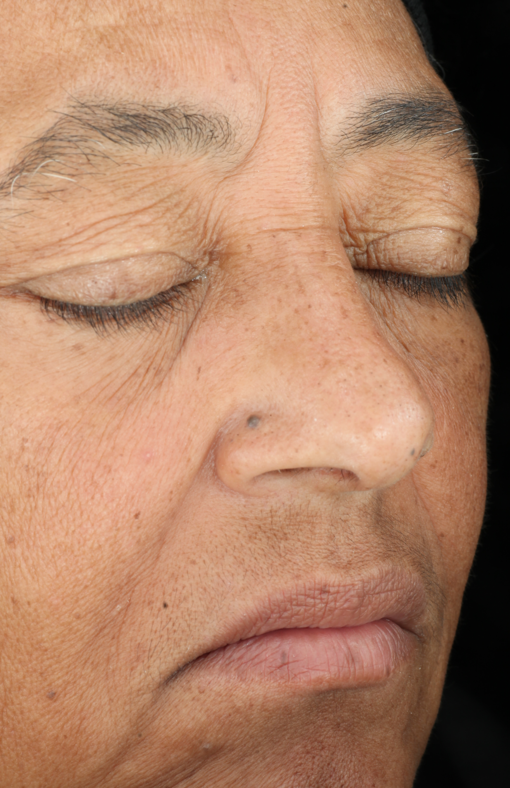 Growth Factor Serum  before-after-2