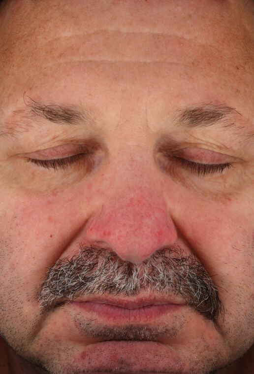 Rozatrol&reg;  before-after-2