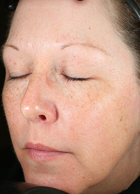Brightalive&reg; (Travel Size)  before-after-2