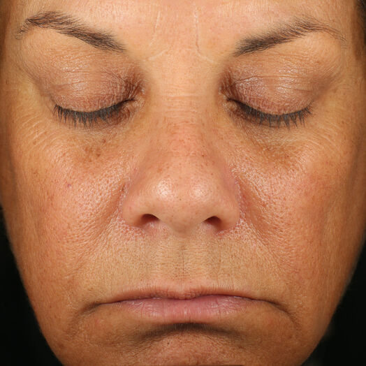 Retinol Skin Brightener 1 Percent  before-after-1